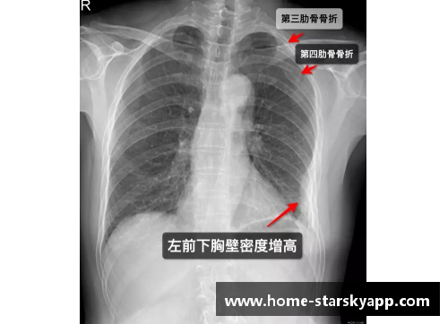 球员肋骨骨折：运动场上的隐形伤痛